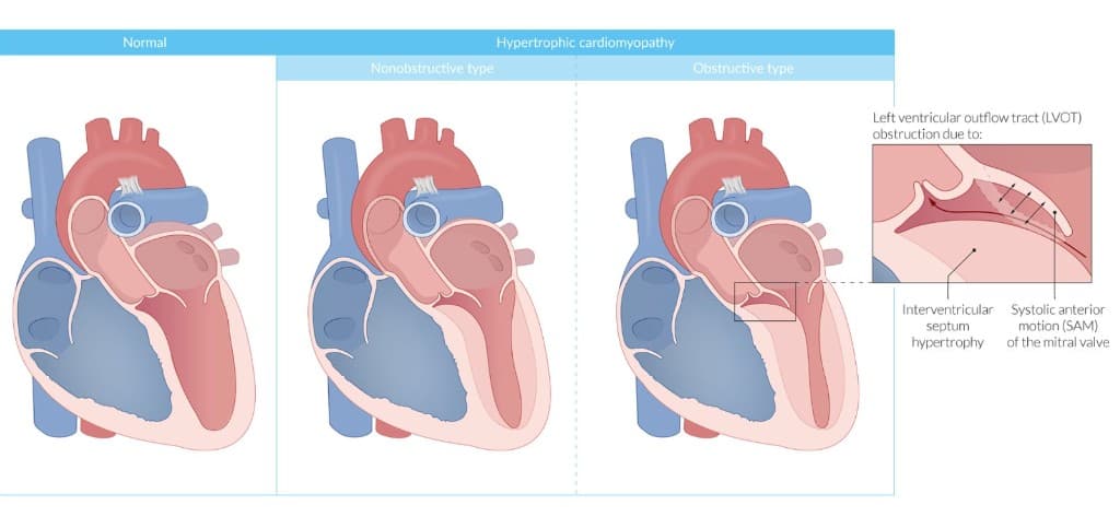 Normal heart compared with non-obstructive and obstructive hypertrophic cardiomyopathy. In the obstructive type, left ventricular outflow tract obstruction is caused by interventricular septal hypertrophy and systolic anterior motion (SAM) of the mitral valve.