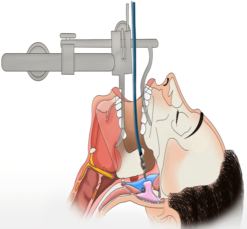 Transoral robotic surgery (TORS) setup for head and neck cancer resection