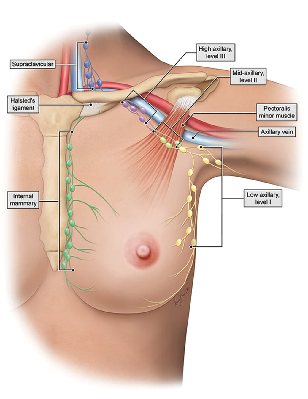Axillary lymph node levels I, II, and III in relation to pectoralis minor