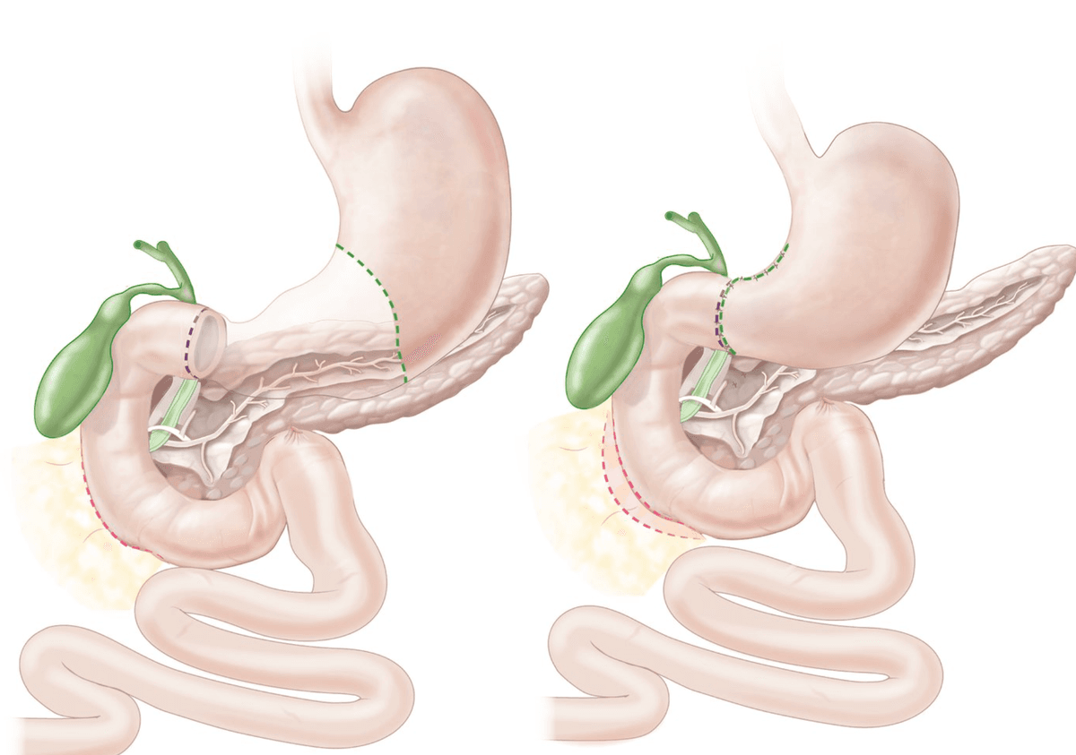 Billroth I reconstruction showing distal gastrectomy followed by gastroduodenostomy