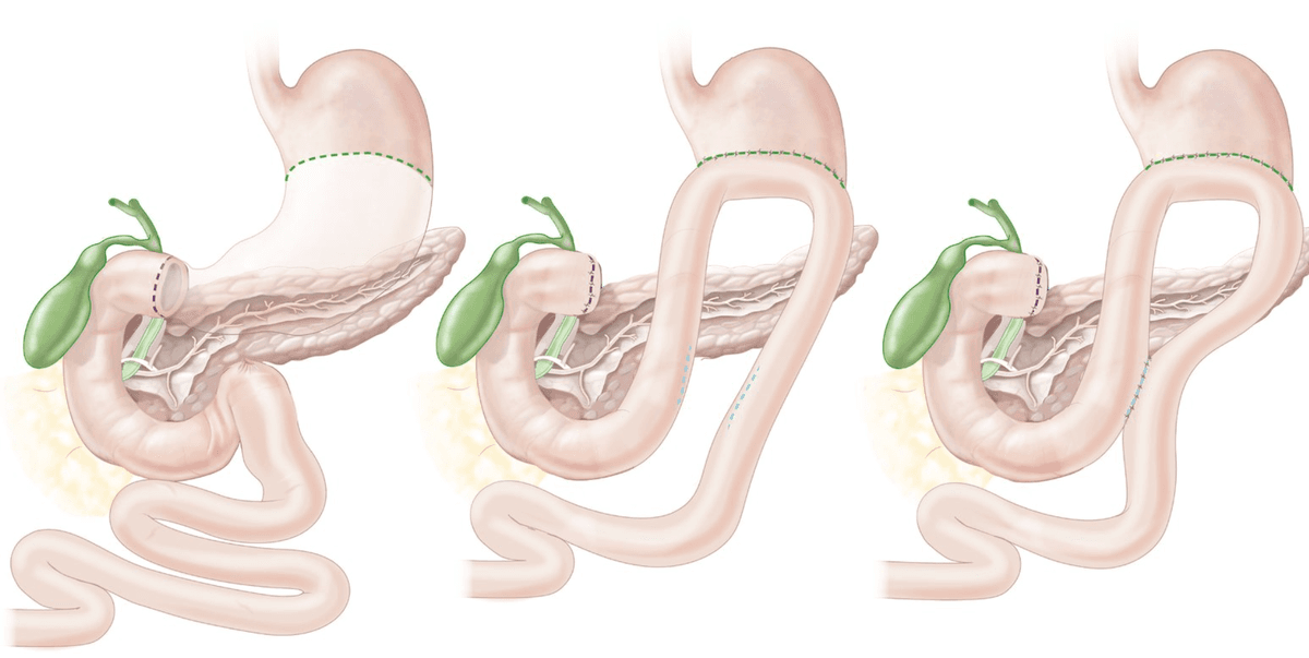 Billroth II reconstruction showing distal gastrectomy followed by gastrojejunostomy