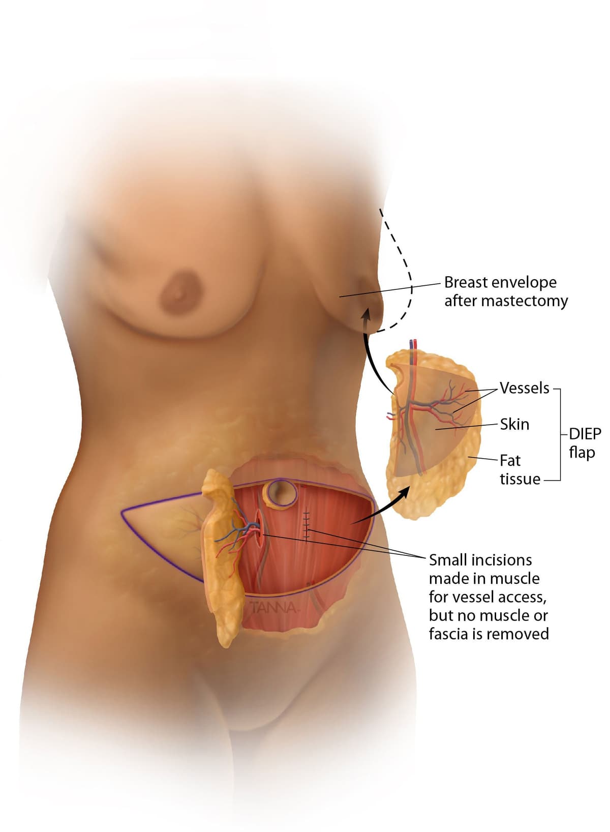DIEP flap breast reconstruction using deep inferior epigastric perforator tissue