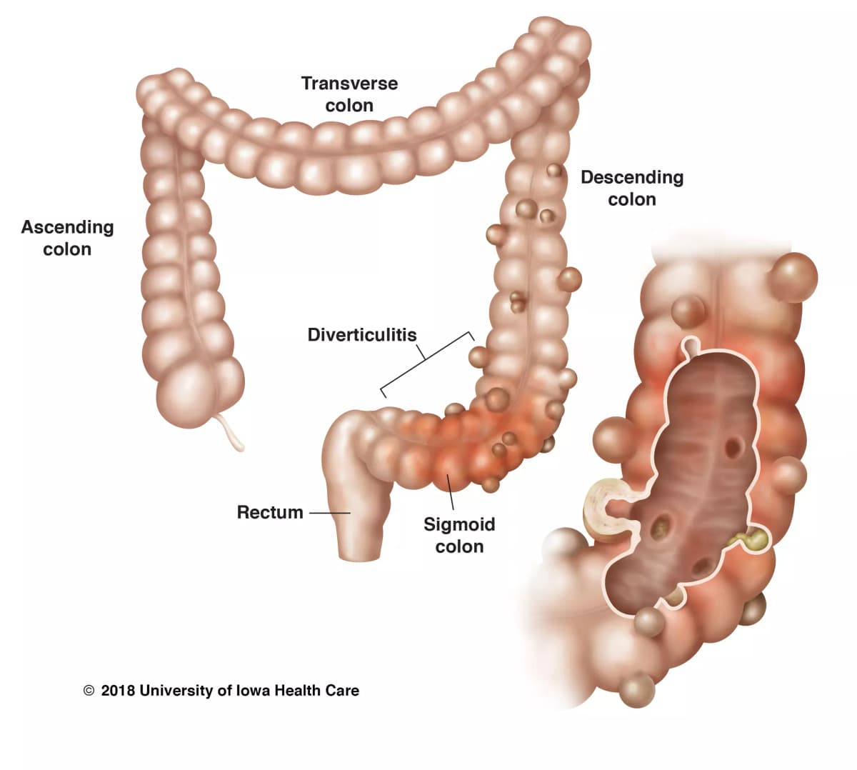 Anatomy and pathophysiology overview of diverticular disease showing diverticula, diverticulitis progression, and key complications