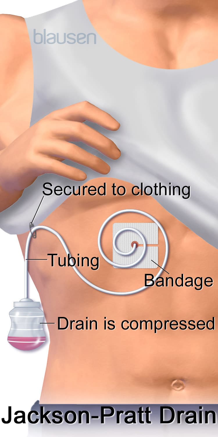 Jackson-Pratt closed-suction drain used after breast surgery