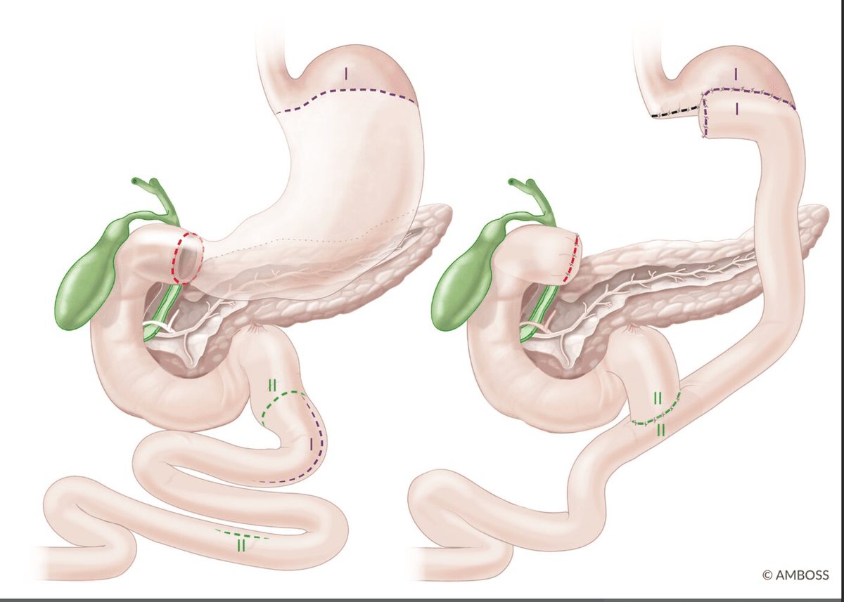 Roux-en-Y reconstruction after gastrectomy, including distal gastrectomy with gastrojejunostomy and total gastrectomy with oesophagojejunostomy