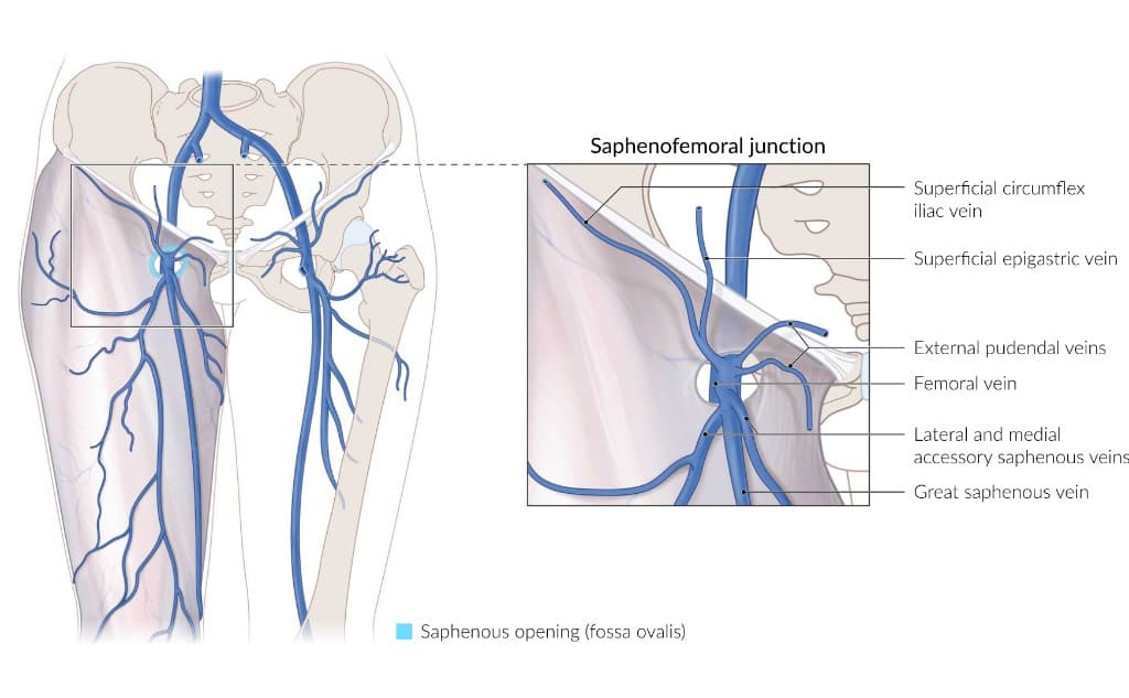 Saphenofemoral junction anatomy showing the confluence of the great saphenous vein, its tributaries (superficial circumflex iliac, superficial epigastric, external pudendal, lateral and medial accessory saphenous veins), and the femoral vein at the saphenous opening