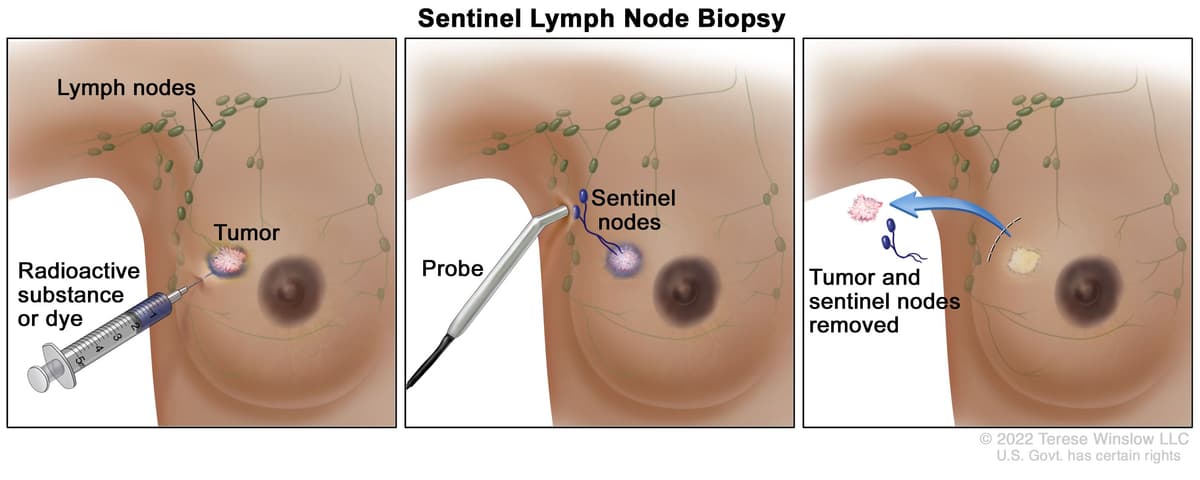 Sentinel lymph node biopsy technique and lymphatic mapping in breast cancer