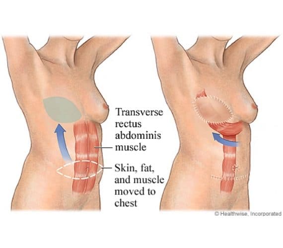TRAM flap breast reconstruction using transverse rectus abdominis myocutaneous tissue