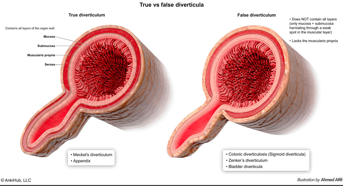Comparison of true versus false diverticulum with bowel wall layers involved