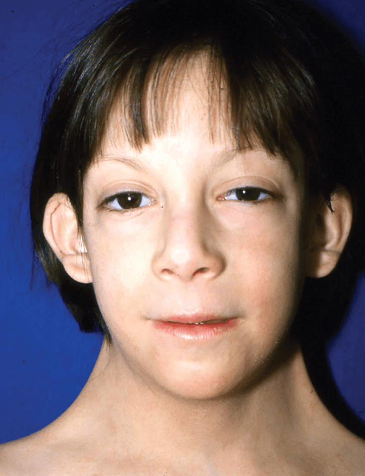 Clinical photograph illustrating characteristic Turner syndrome features including webbed neck, low-set ears, and epicanthal folds