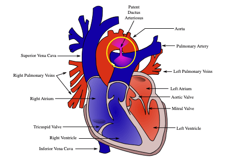 Heart diagram showing a patent ductus arteriosus, highlighted by a yellow circle.