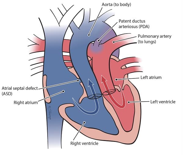 Heart diagram of transposition of the great arteries showing the aorta arising from the right ventricle, the pulmonary artery arising from the left ventricle, and mixing through an atrial septal defect and a patent ductus arteriosus